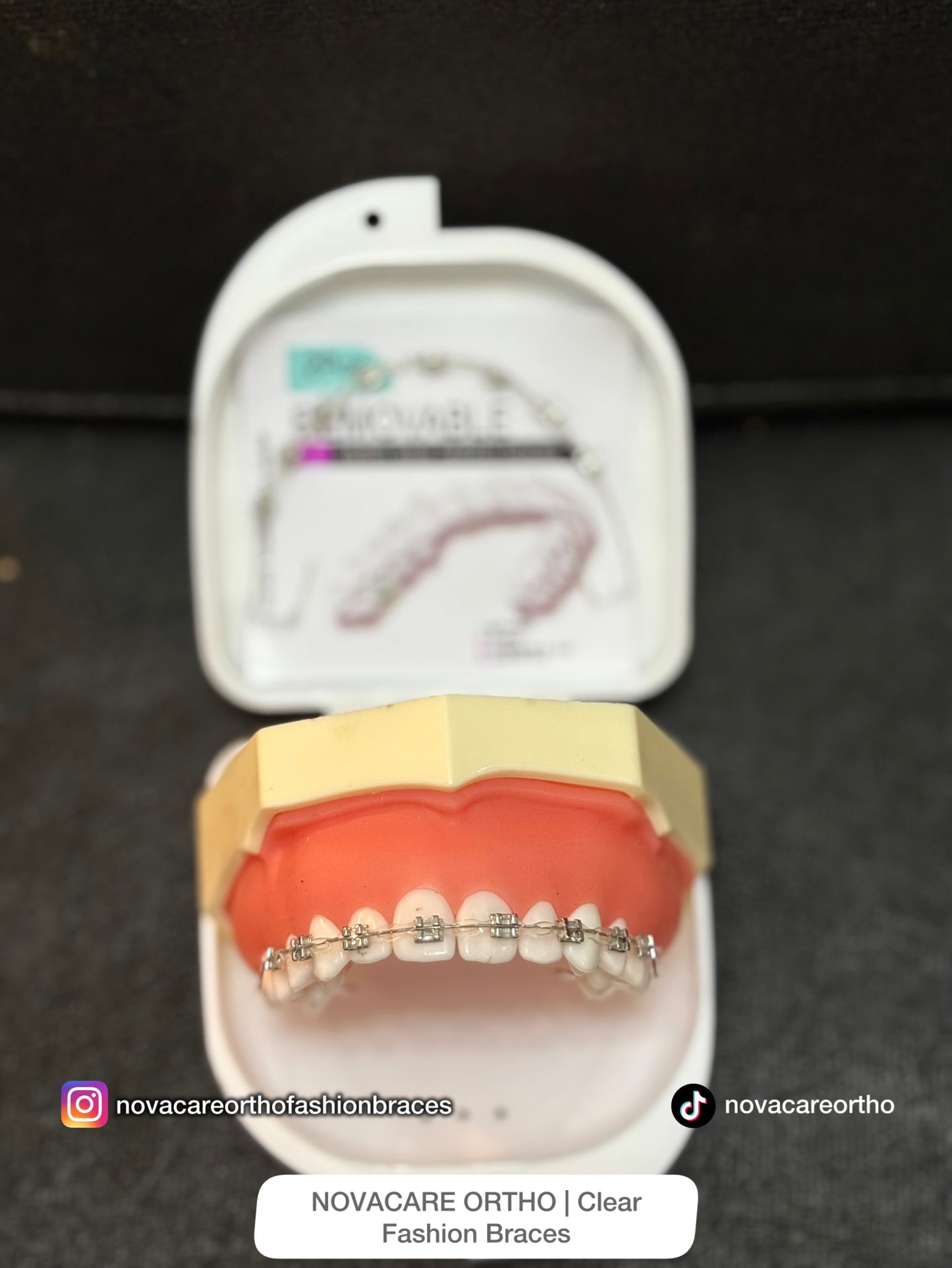 Clip Removable Braces🌟(Top & Bottom) – with Free Retainer Case🌟