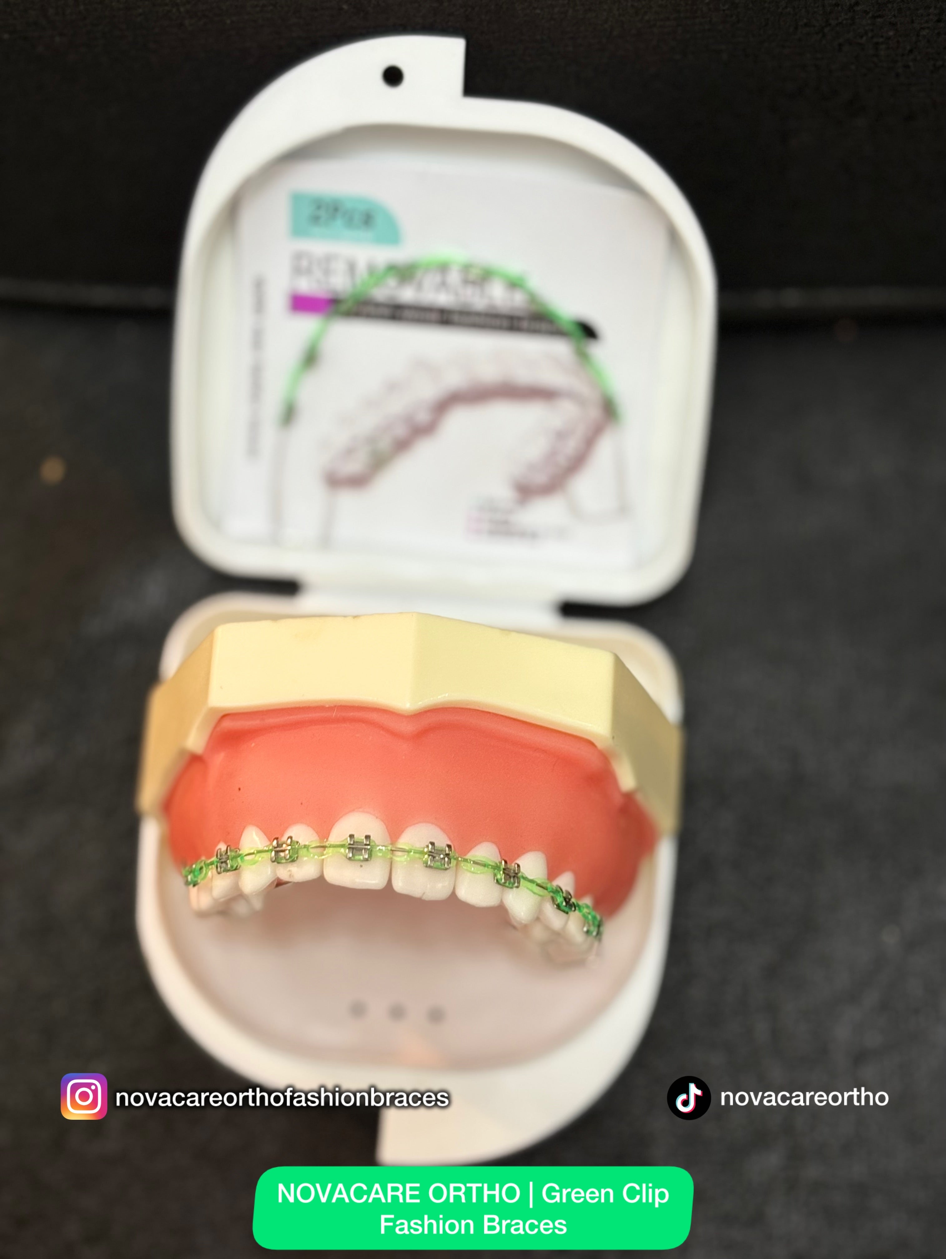 Clip Removable Braces🌟(Top & Bottom) – with Free Retainer Case🌟