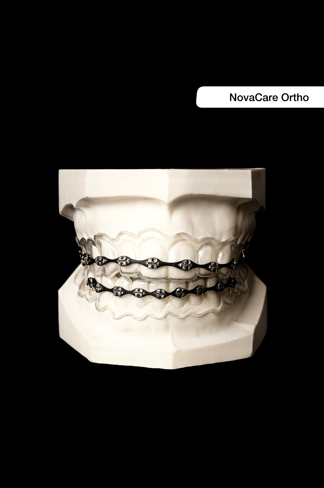 Custom-Made Fashion Retainer Braces